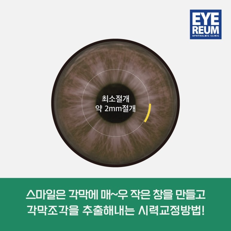 직장인라식 왜 "로우에너지 스마일라식 ?"