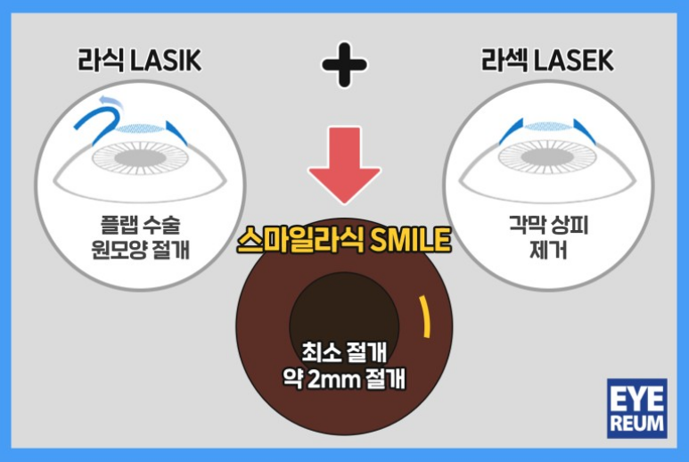 직장인라식 왜 "로우에너지 스마일라식 ?" 사진 2