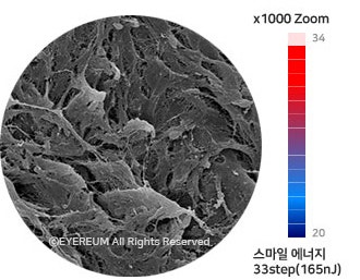 스마일라식, 라섹, 렌즈삽입술 - 1:1 맞춤수술은 어떻게 다를까? 사진 4