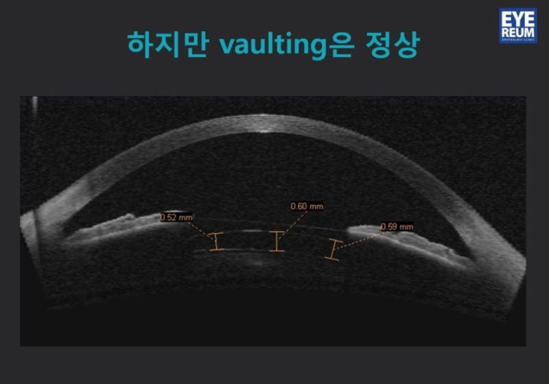 ICL렌즈삽입술, 렌즈종류 및 특징 사진 7