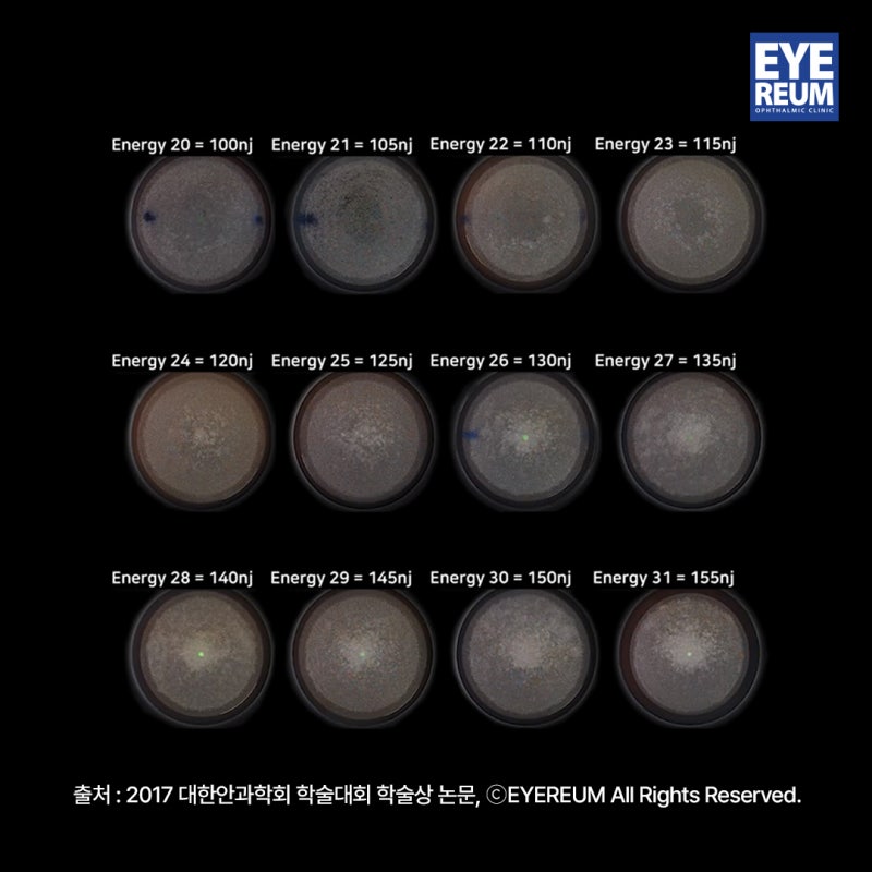 난시교정 해법 제시한 스마일라식 '벡터플래닝' 이란? 사진 5