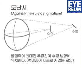 렌즈삽입술 비용 함께 체크해요 사진 7