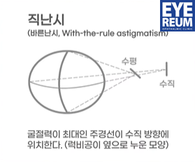렌즈삽입술 비용 함께 체크해요 사진 6