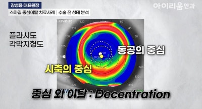 스마일라식 재수술(고위수차 치료)_아이리움안과 강성용원장 사진 6