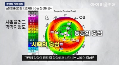 스마일라식 재수술(고위수차 치료)_아이리움안과 강성용원장 사진 5