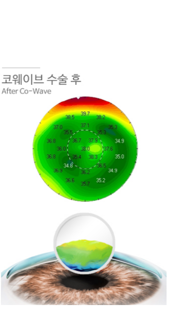스마일라식 라섹 차이, 이렇게 비교했어요 사진 18