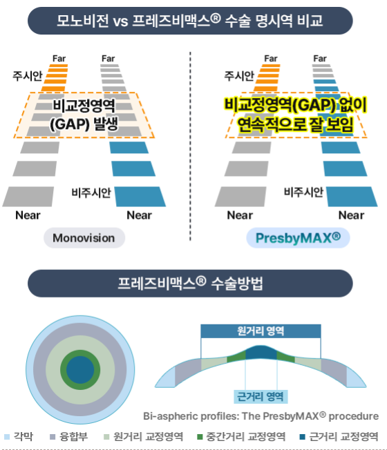 노안수술 후기 노안교정수술가격 요약본(24년 9월 기준) 사진 10