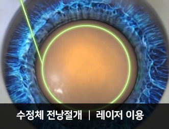 백내장수술 머리감기 방법: 강남 아이리움안과 사후관리 사진 2