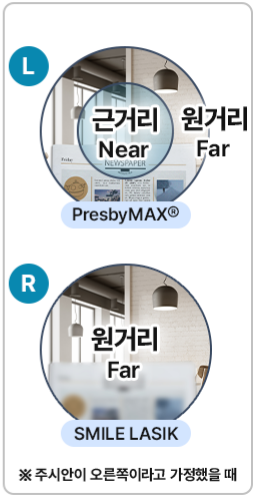 50대 노안수술 고려한다면 필독 사진 7