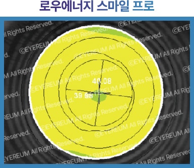 스마일 라식 라섹 차이 /비용 장단점 궁금증 깔끔 정리 사진 13