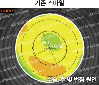 스마일 라식 라섹 차이 /비용 장단점 궁금증 깔끔 정리 사진 12