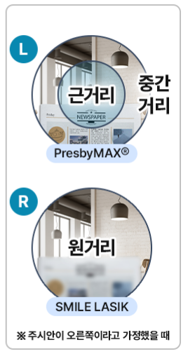 40대 라식 노안교정수술 고려할때 사진 12