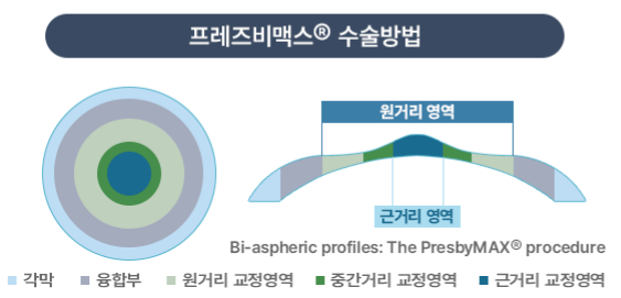 40대 라식 노안교정수술 고려할때 사진 11
