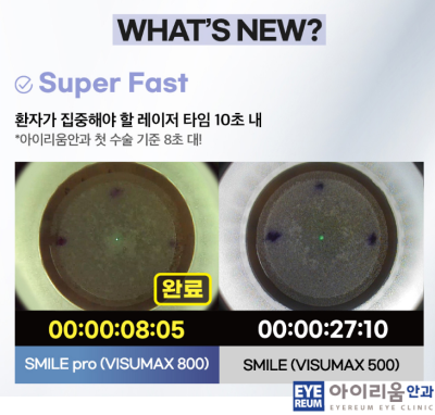 스마일프로라식 ※ 플라즈마 스마일 바로알기 사진 13