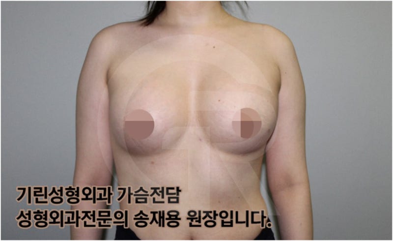 가슴확대수술 후 관리방법, 실제사례 알아보다. [기린성형외과의원_Dr.송재용] 사진 15