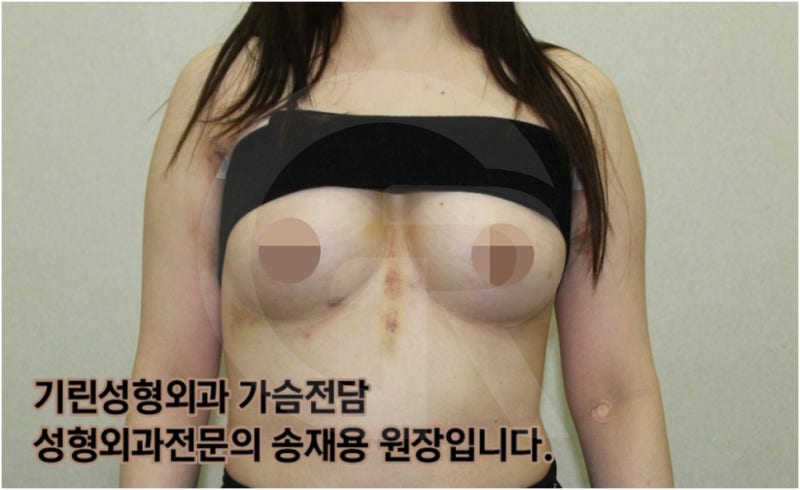 가슴확대수술 후 관리방법, 실제사례 알아보다. [기린성형외과의원_Dr.송재용] 사진 5