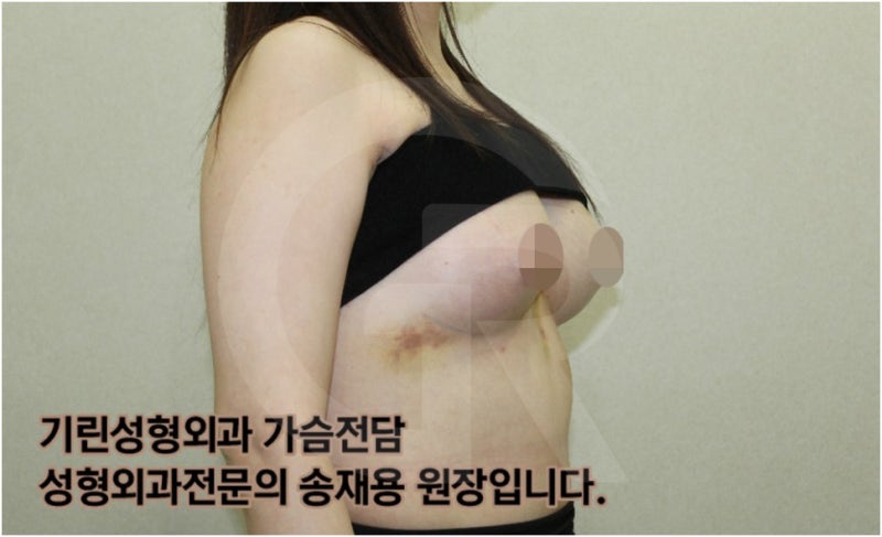가슴확대수술 후 관리방법, 실제사례 알아보다. [기린성형외과의원_Dr.송재용] 사진 6