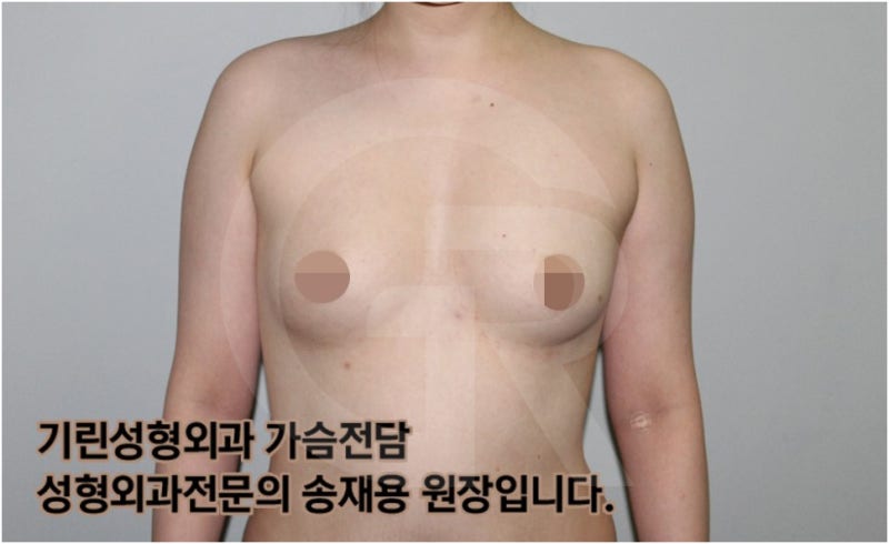 가슴확대수술 후 관리방법, 실제사례 알아보다. [기린성형외과의원_Dr.송재용] 사진 14