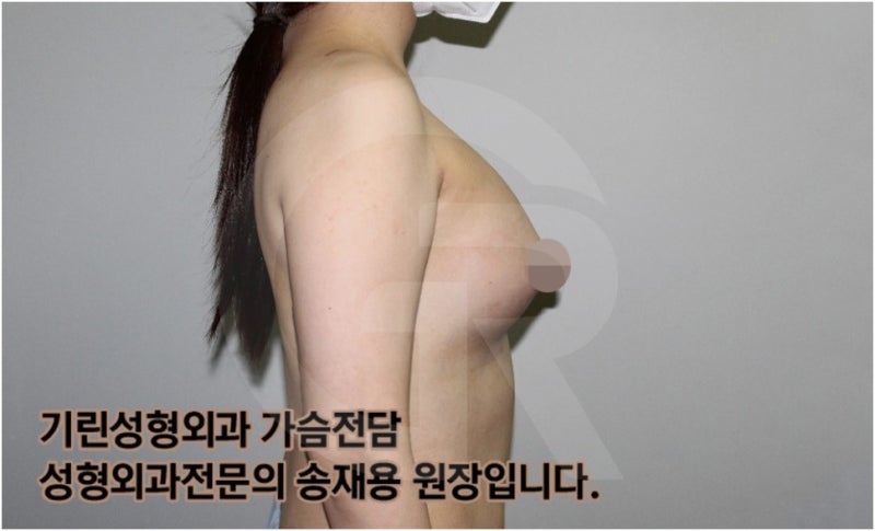 가슴확대수술 후 관리방법, 실제사례 알아보다. [기린성형외과의원_Dr.송재용] 사진 10
