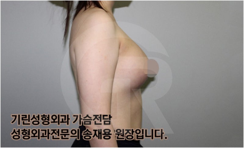 가슴확대수술 후 관리방법, 실제사례 알아보다. [기린성형외과의원_Dr.송재용] 사진 13