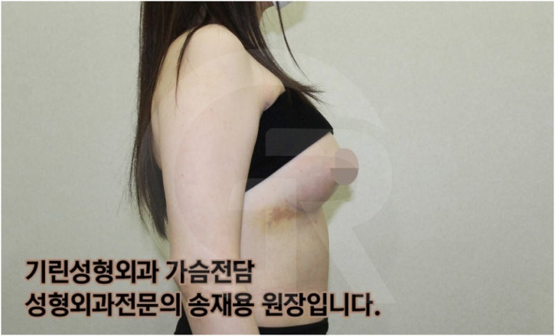 가슴확대수술 후 관리방법, 실제사례 알아보다. [기린성형외과의원_Dr.송재용] 사진 8