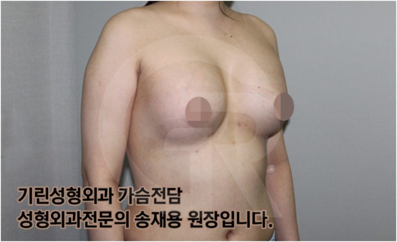 가슴확대수술 후 관리방법, 실제사례 알아보다. [기린성형외과의원_Dr.송재용] 사진 9