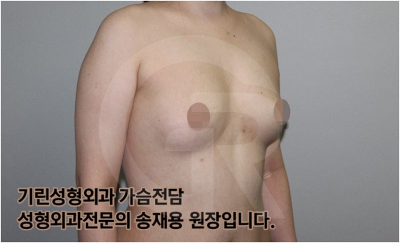 가슴확대수술 후 관리방법, 실제사례 알아보다. [기린성형외과의원_Dr.송재용] 사진 2