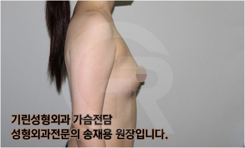 가슴확대수술 후 관리방법, 실제사례 알아보다. [기린성형외과의원_Dr.송재용]
