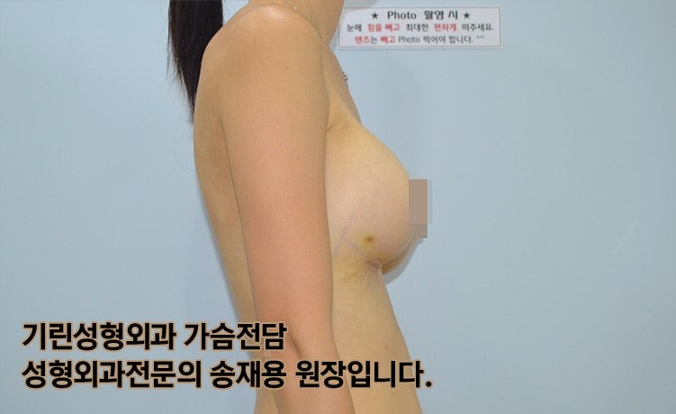 [가슴성형절개방식]밑선절개 흉터와 회복기간 (+실제사례) 사진 7