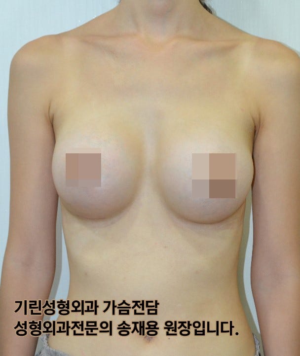 [가슴성형절개방식]밑선절개 흉터와 회복기간 (+실제사례) 사진 11
