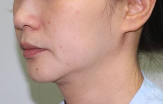 비수술 리프팅, 어떤 종류가 있을까? 사진 2