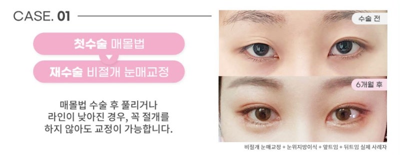 소세지눈재수술? 더는 실패 없는 비법 1가지 사진 2