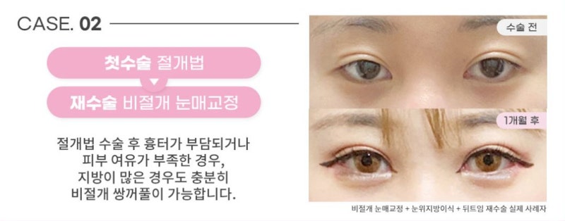 소세지눈재수술? 더는 실패 없는 비법 1가지 사진 3
