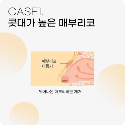 매부리코수술? 콧대만 깎는다고 해결 될까? 사진 5
