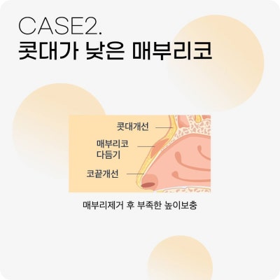 매부리코수술? 콧대만 깎는다고 해결 될까? 사진 6