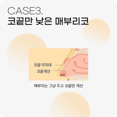 매부리코수술? 콧대만 깎는다고 해결 될까? 사진 7