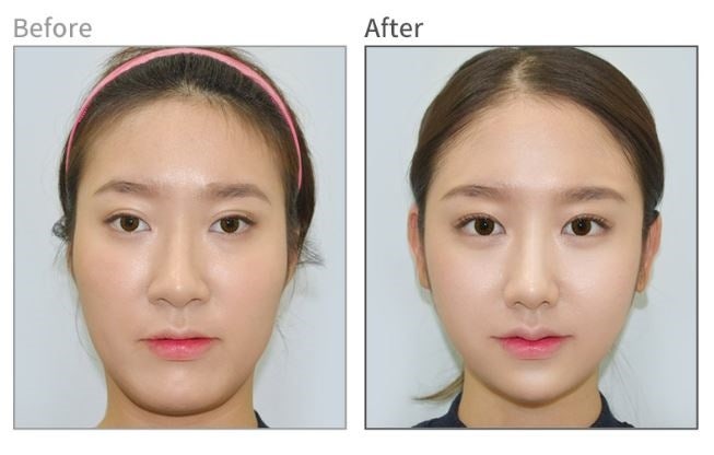 안면윤곽후기? 사실 도움 안 되는 이유