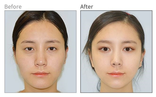 안면윤곽후기? 사실 도움 안 되는 이유