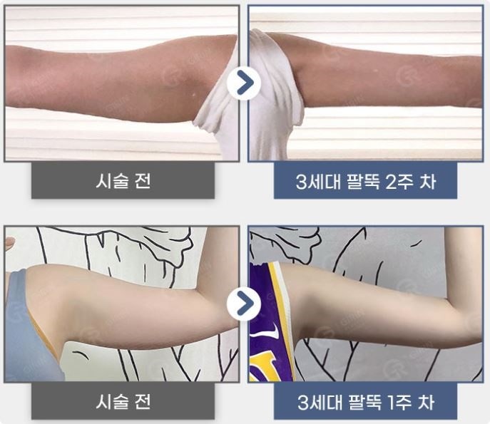 강남지방분해주사, 의미 없는 유형은? 사진 6