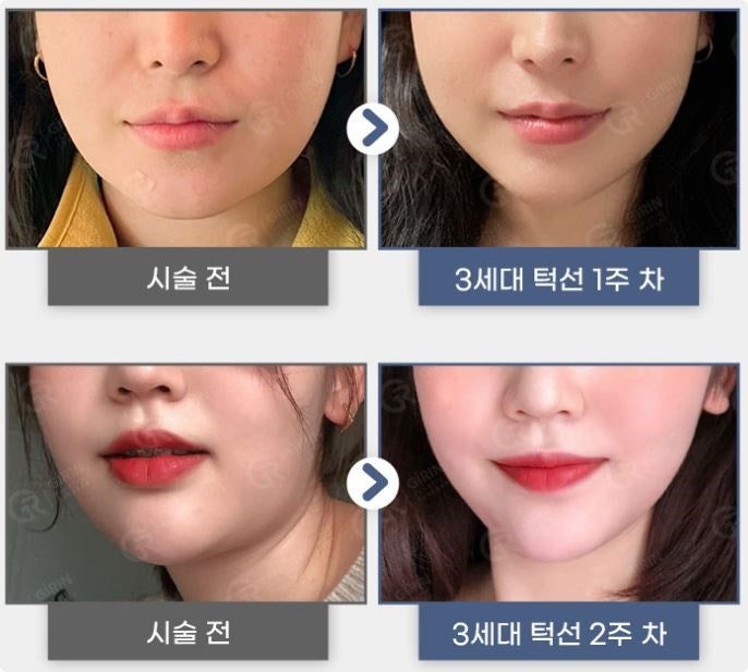 강남지방분해주사, 의미 없는 유형은? 사진 4