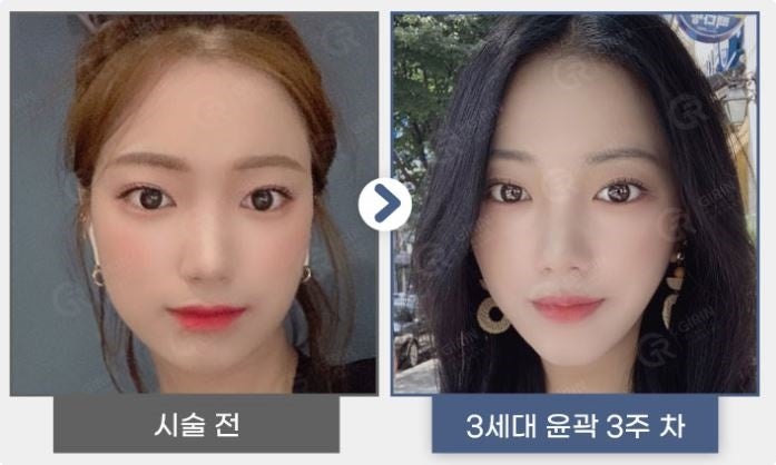 강남지방분해주사, 의미 없는 유형은? 사진 3