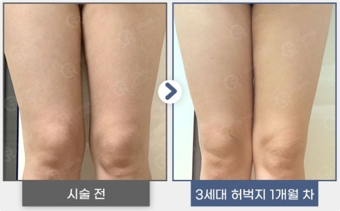 강남지방분해주사, 의미 없는 유형은? 사진 5