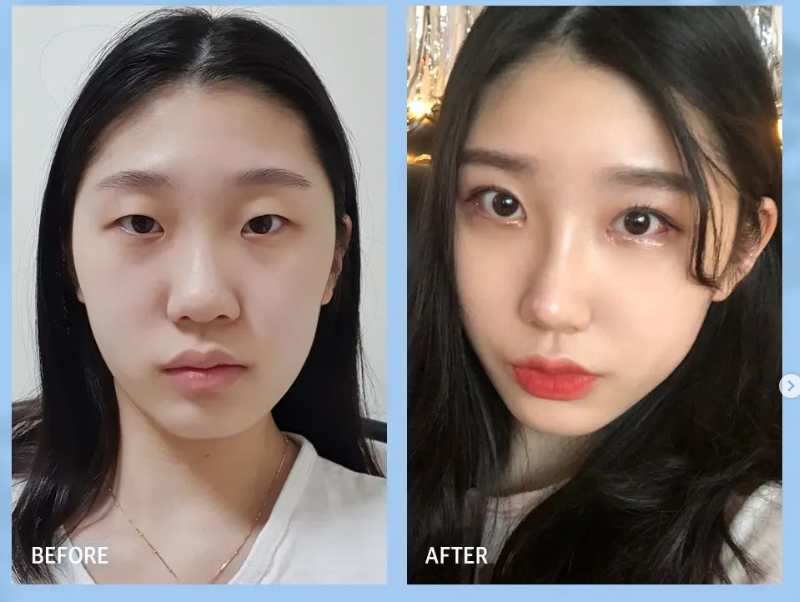 낮은코수술 눈에 보이는 차이를 원한다면 사진 13