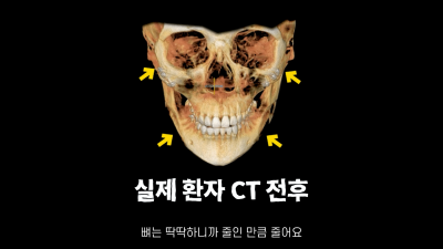 [기린성형외과]성형해도 답 없는 얼굴 _긴얼굴편 사진 8