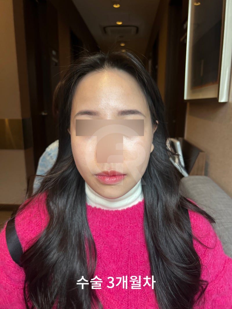 연조직윤곽술, 시간이 지날수록 자연스러운 얼굴선 사진 5