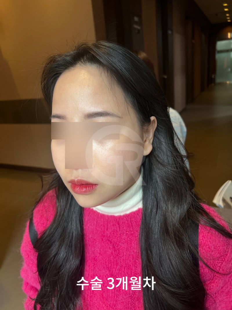 연조직윤곽술, 시간이 지날수록 자연스러운 얼굴선 사진 6