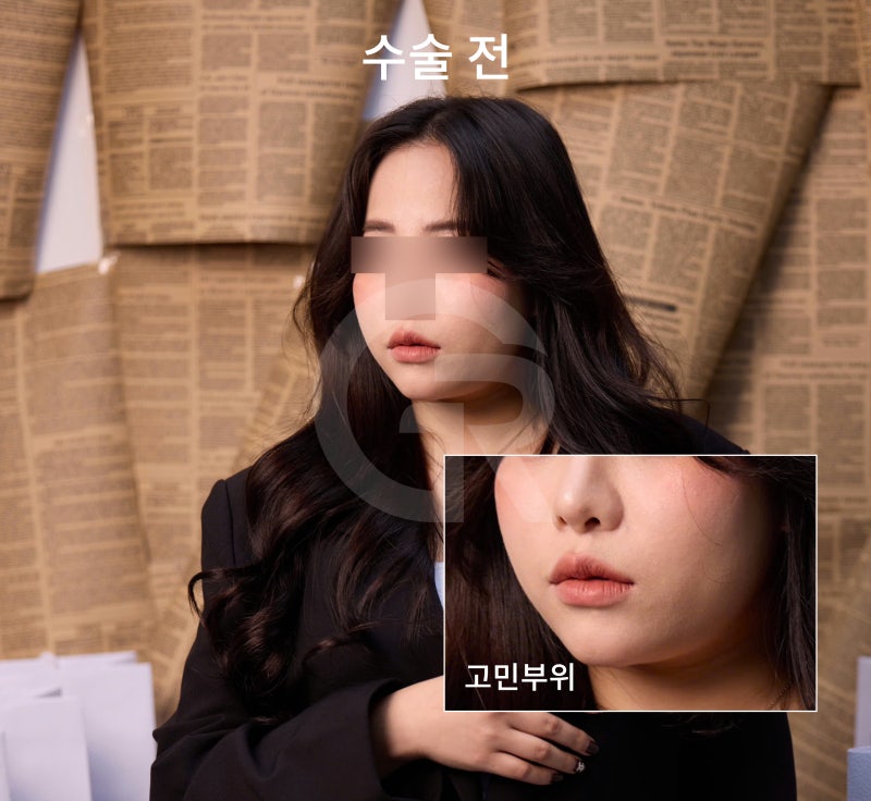 연조직윤곽술, 시간이 지날수록 자연스러운 얼굴선