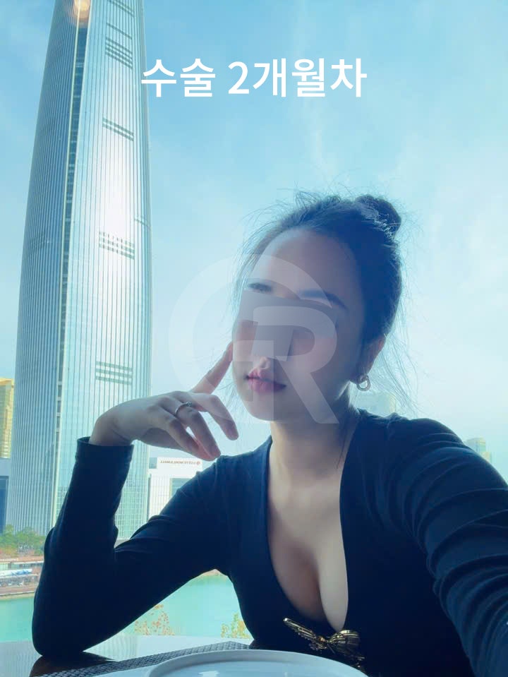 연조직윤곽술, 시간이 지날수록 자연스러운 얼굴선 사진 4
