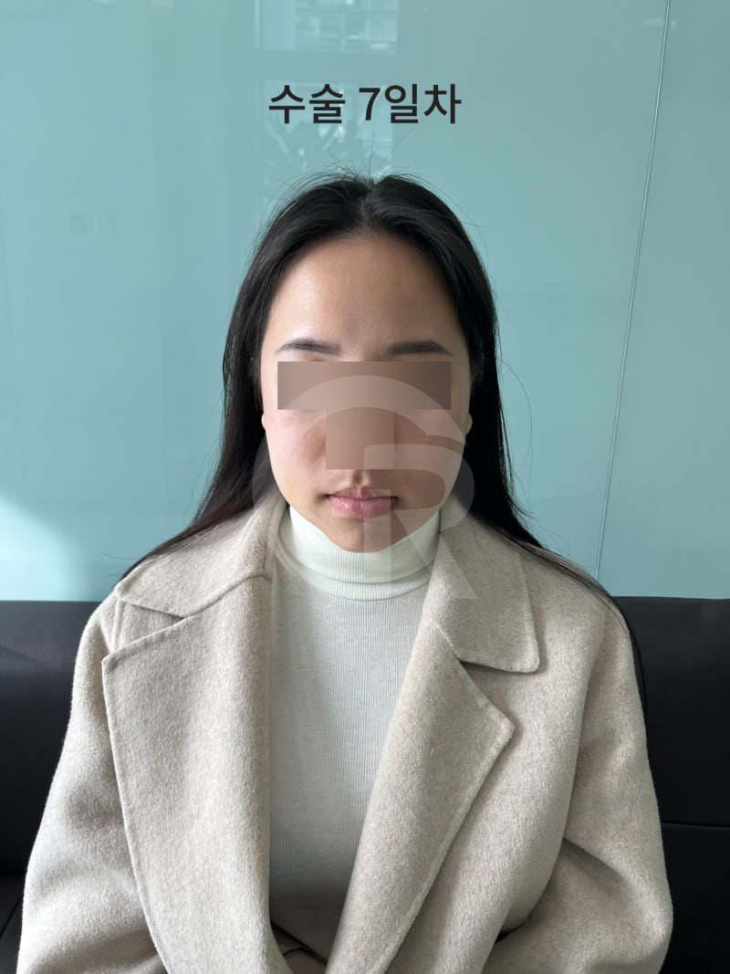 연조직윤곽술, 시간이 지날수록 자연스러운 얼굴선 사진 2