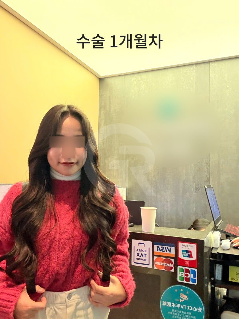 연조직윤곽술, 시간이 지날수록 자연스러운 얼굴선 사진 3
